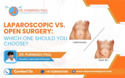 Laparoscopic vs. Open Surgery: Which One Should You Choose?
